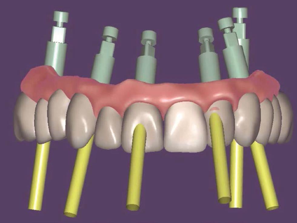 1-Year Evaluation of OT Bridge Abutments for Immediately Loaded Maxillary Fixed Restorations: A Multicenter Study